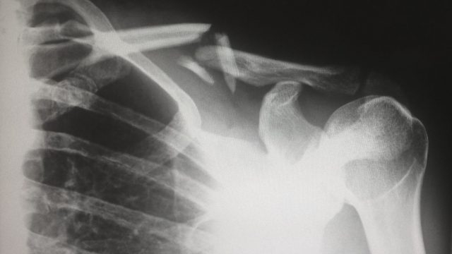 Xray of broken bone in the shoulder